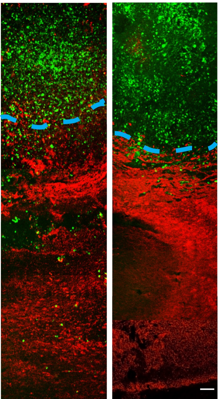 Images showing that in vivo delivery of imipramine blue yields decreased invasion of the tumor